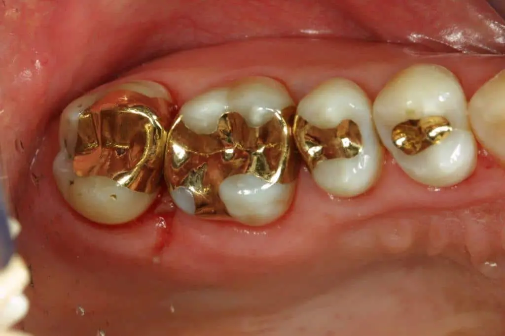 dental onlays and inlays