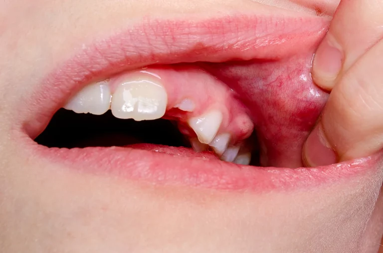 Enfermedades de los dientes