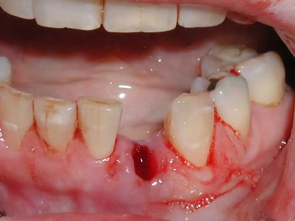 Cirugias Orales