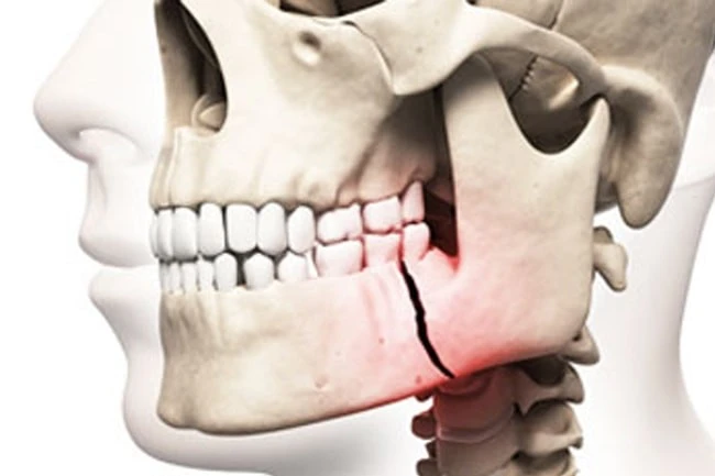 Dental Injuries: All You Need to Know