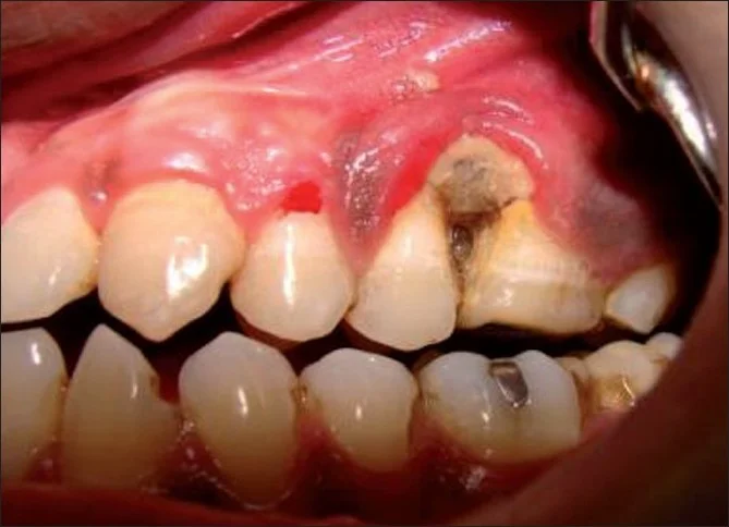 Enfermedades dentales misceláneas