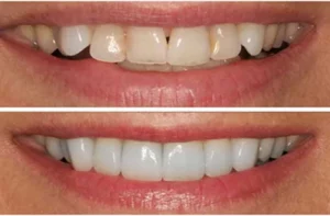 Teeth Reshaping