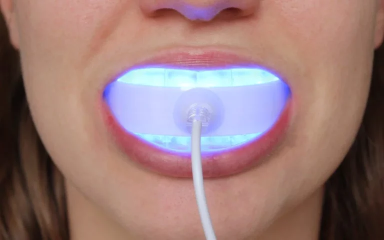 Teeth Whitening: The Ultimate Guide