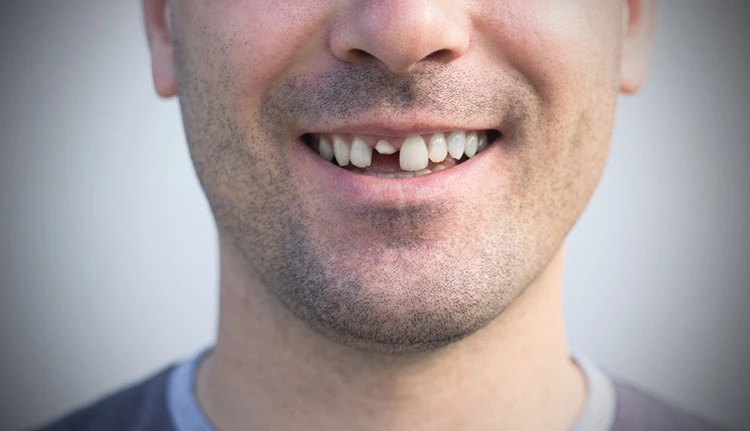 Dental Trauma Restorations