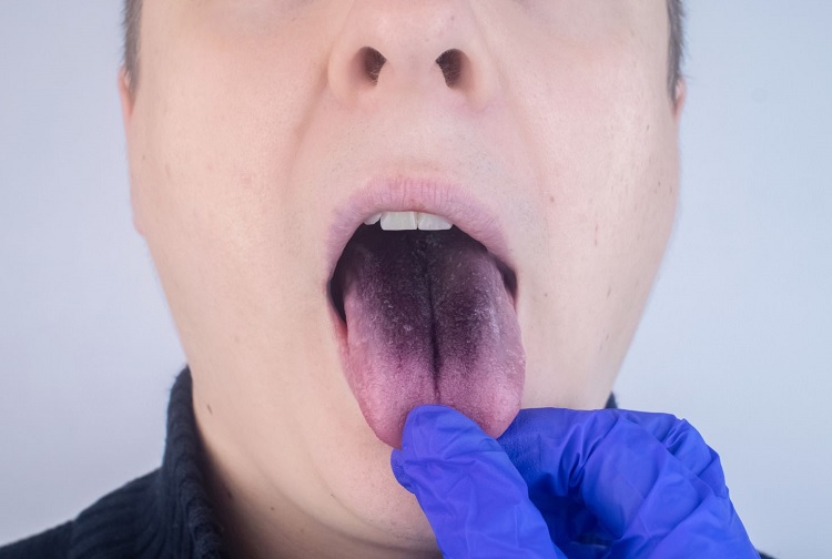 dentist-holding-a-patients-black-tongue