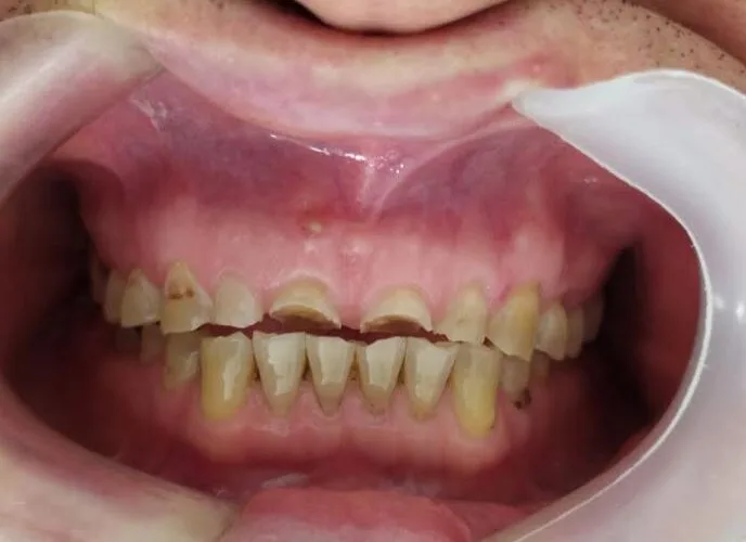 Dental Diseases