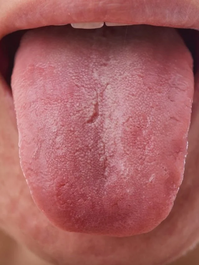 close-up-burning-mouth-syndrome-tongue