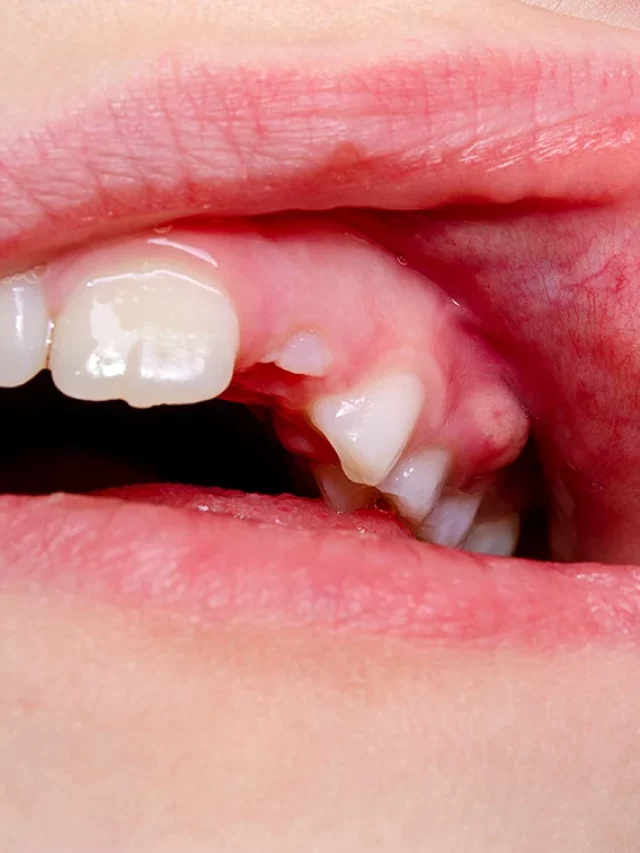 the-potential-of-tooth-infection-to-spread-to-your-jaw-and-face