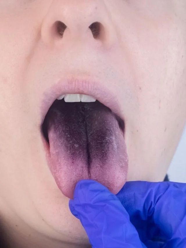 dentist-holding-a-patients-black-tongue