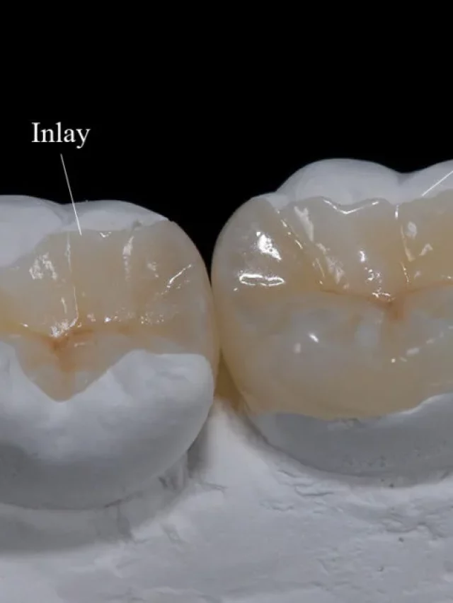 inlay vs onlay