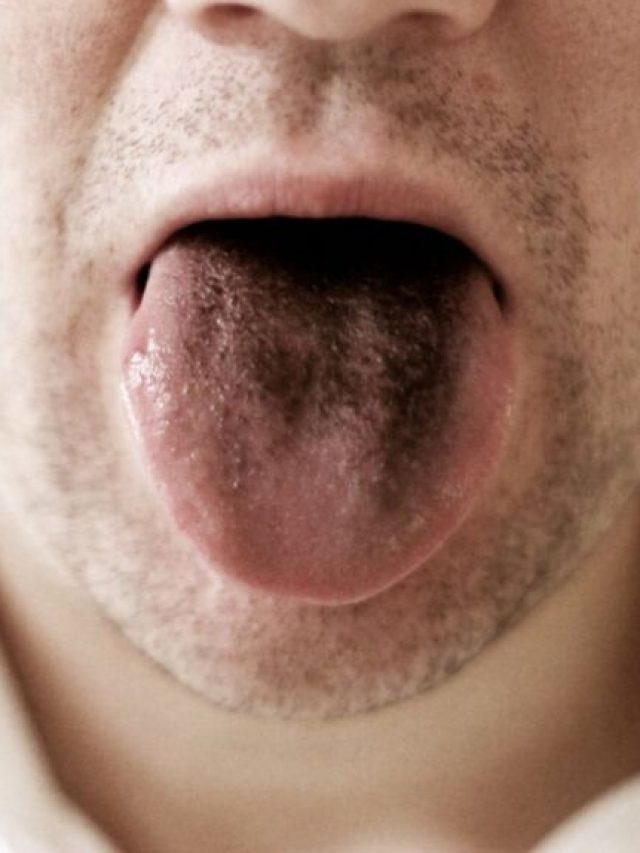 2 Essential Approaches to Black Tongue Treatment