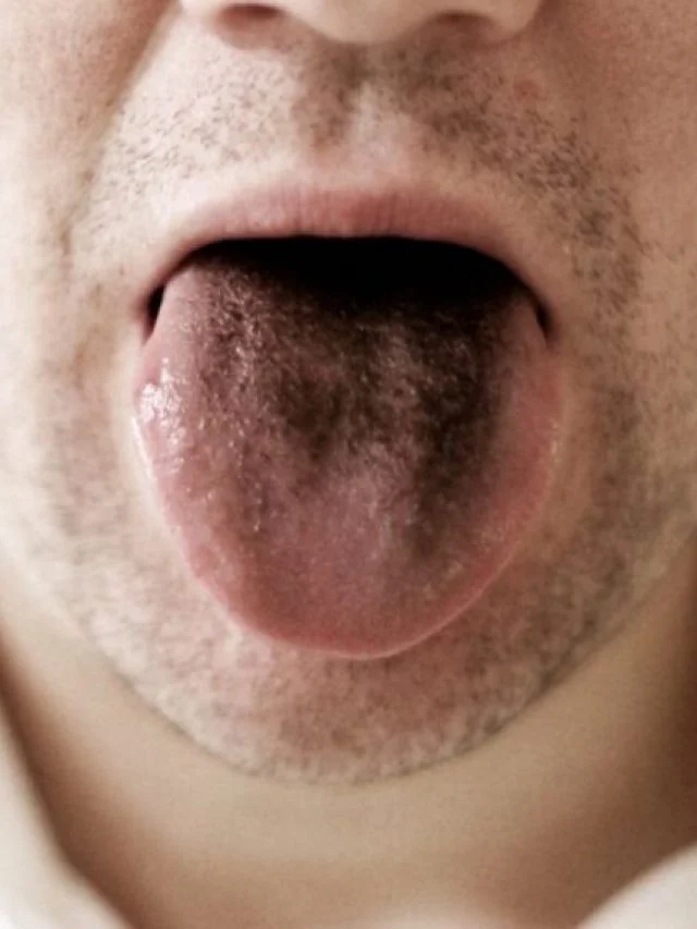 Black tongue treatment