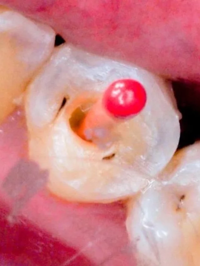 The Truth Between Root Canals and Cancer (3 Other Myths) World of Dentistry