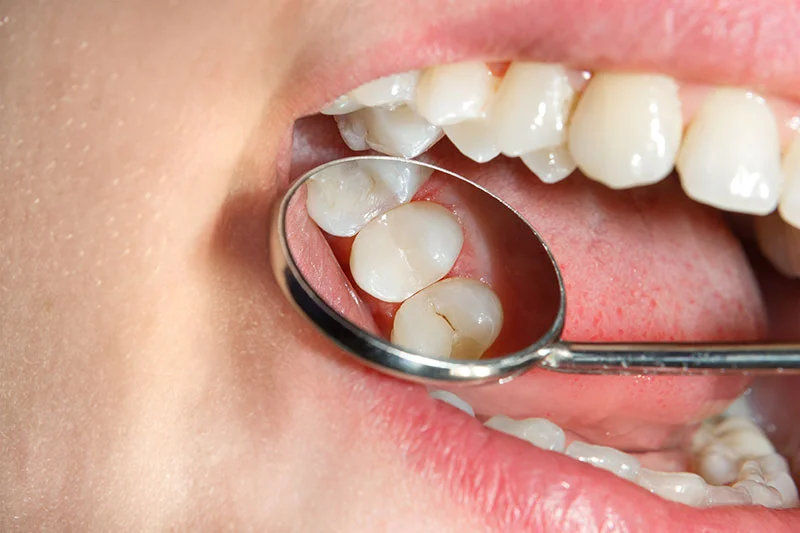 Selladores dentales
