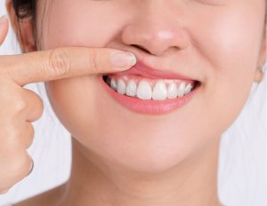 girl-having-trench-mouth
