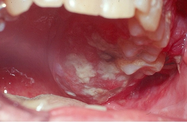 Oral Cancers