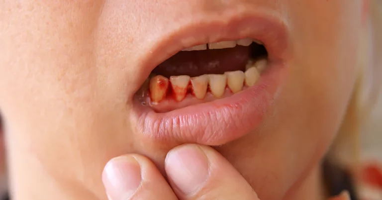 Trauma to the Mouth or Teeth