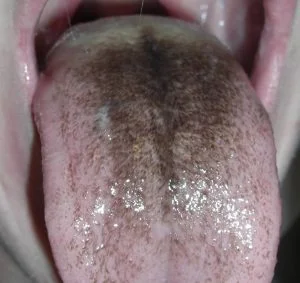 Black Tongue Treatment: 2 Effective Ways To Prevent It