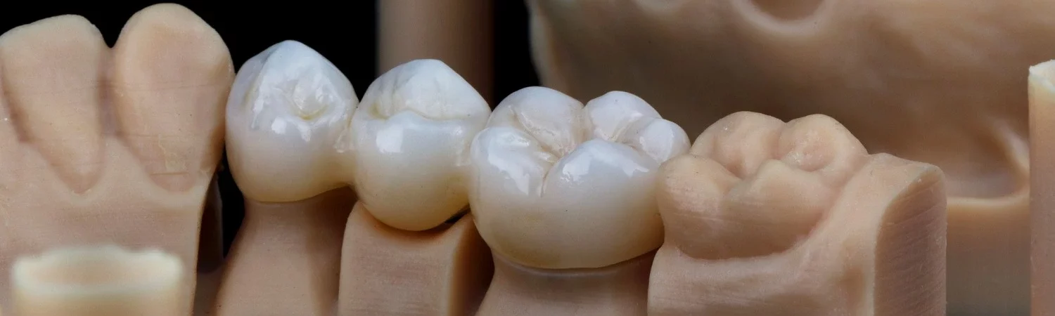 Procedimiento de corona dental​