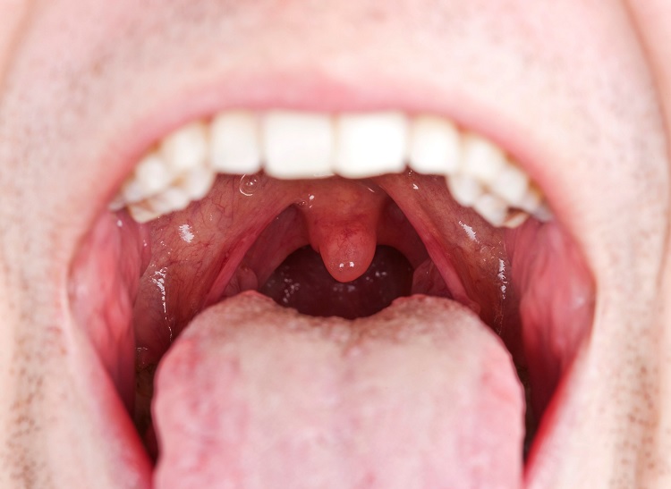 frenectomy