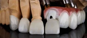 What is Dental Bonding? (3 Helpful Benefits You Should Know)
