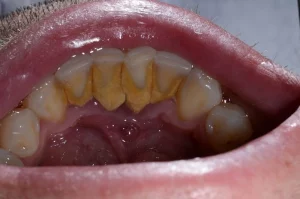 Effects of periodontal disease