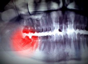 Extraction of impacted teeth