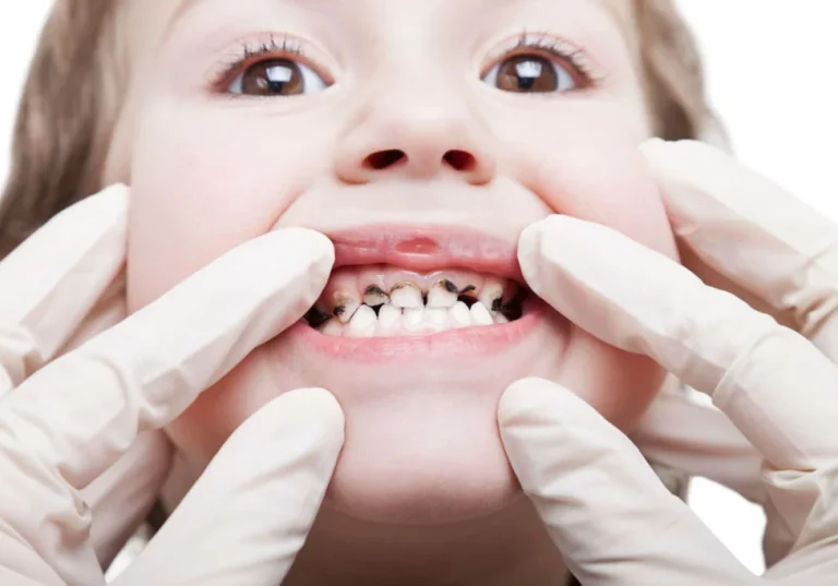 Problemas Dentales Pediátricos Comunes