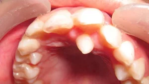 Problemas Dentales Pediátricos Comunes