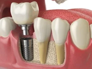 5 Proper Steps in Dental Implant Procedure You Should Know