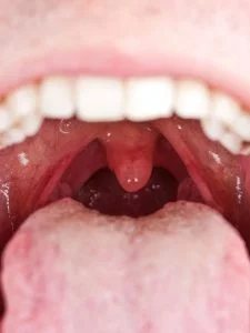 frenectomy