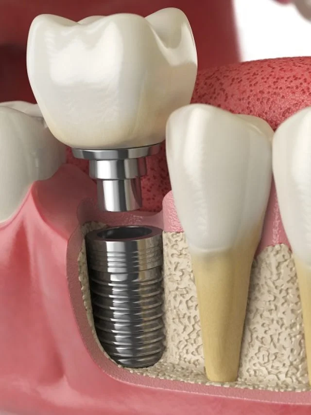 dental-implant-procedure-anatomy