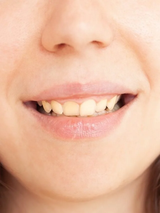 person-smiles-shows-teeth-yellow-plaque