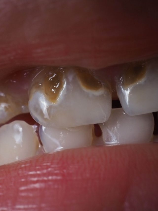 3 Proven Treatments For Enamel Erosion: Signs And Symptoms