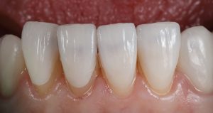 dental bonding cost
