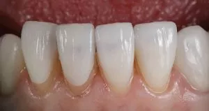 dental bonding cost