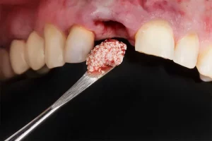 bone grafting