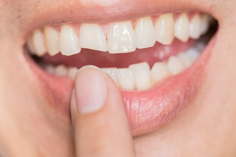Dental Trauma Restorations