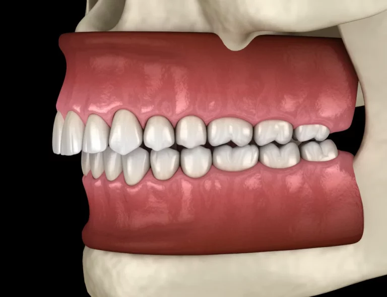 Jaw and Bite Correction