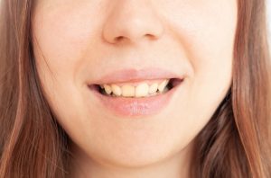 person-smiles-shows-teeth-yellow-plaque