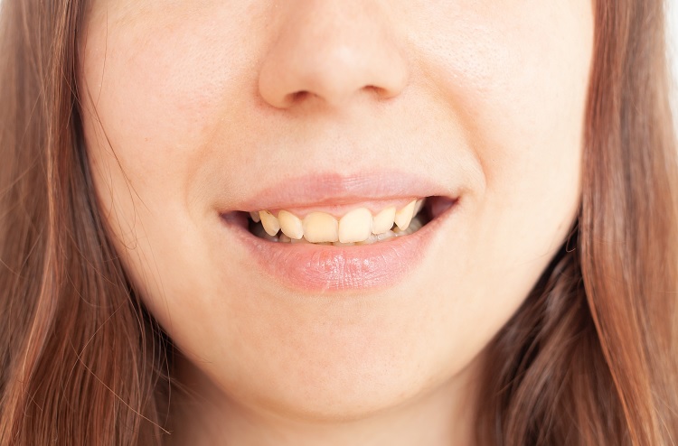 person-smiles-shows-teeth-yellow-plaque
