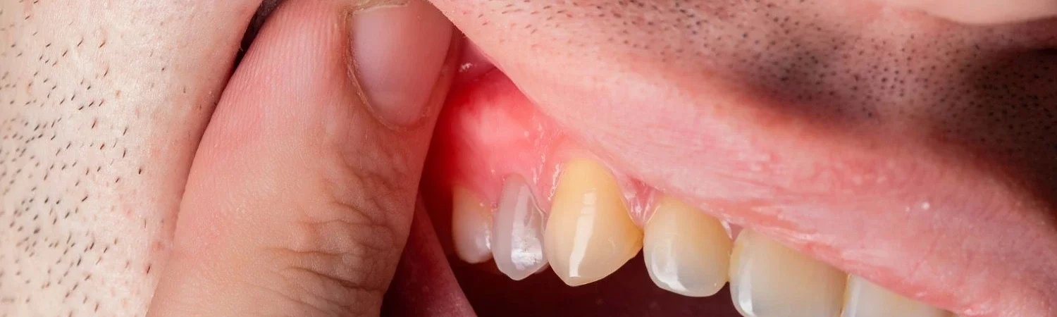 granuloma dental