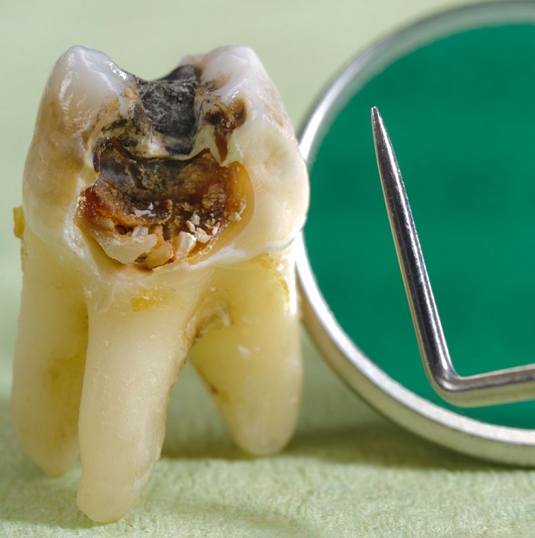 internal-tooth-resorption