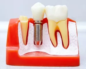¿Qué es el injerto óseo dental? 4 tipos conocidos