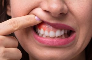 girl-having-dental-granuloma