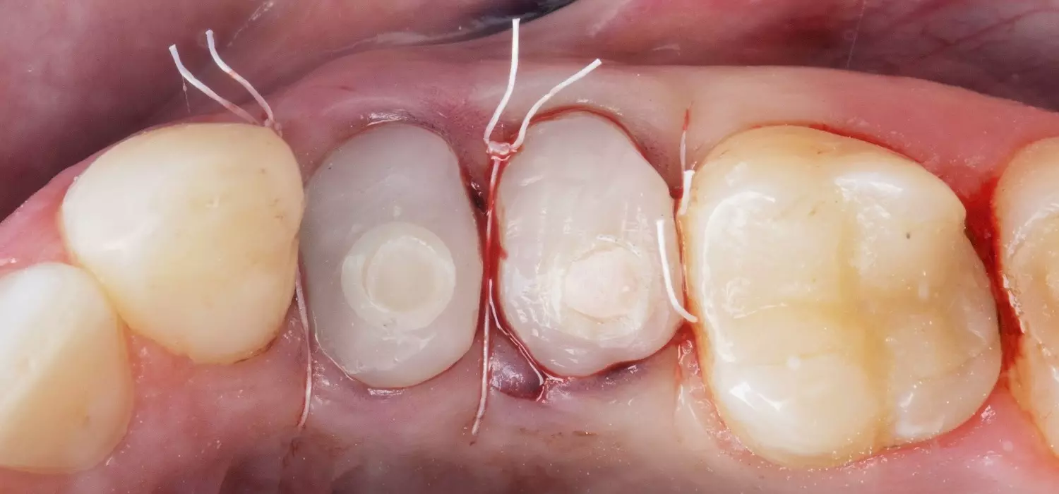 Dentina expuesta