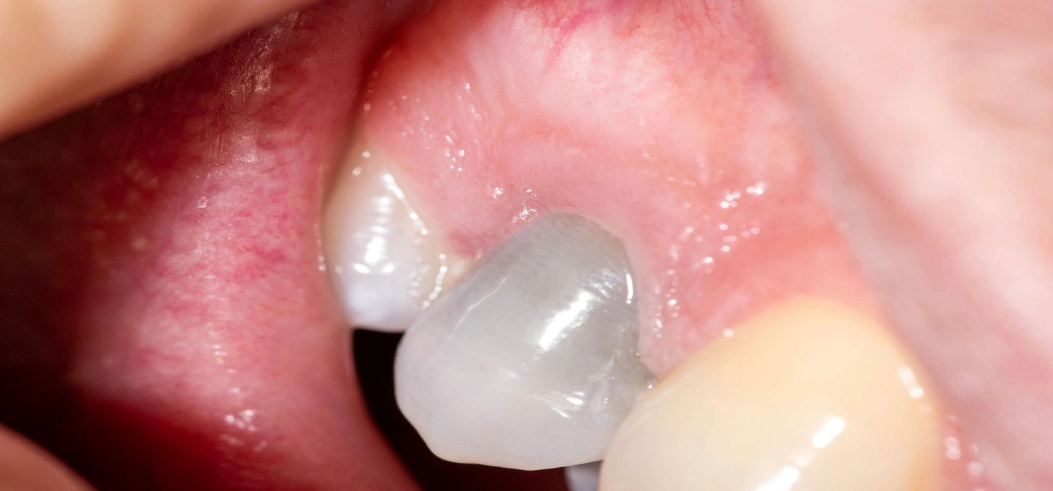 Infección dental que se propaga al hueso