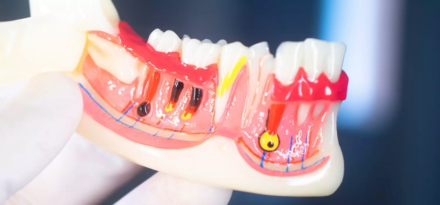 Reabsorción interna del diente
