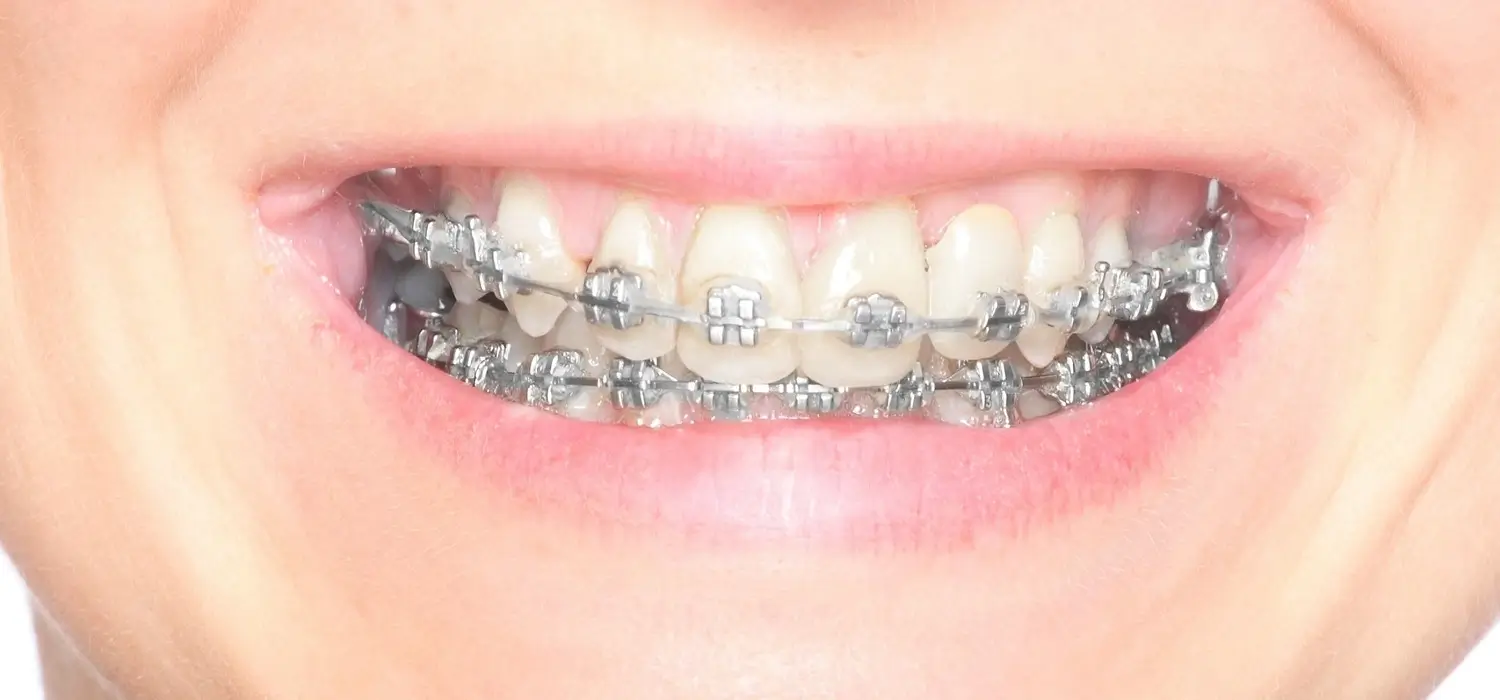 cavities-caused-by-braces