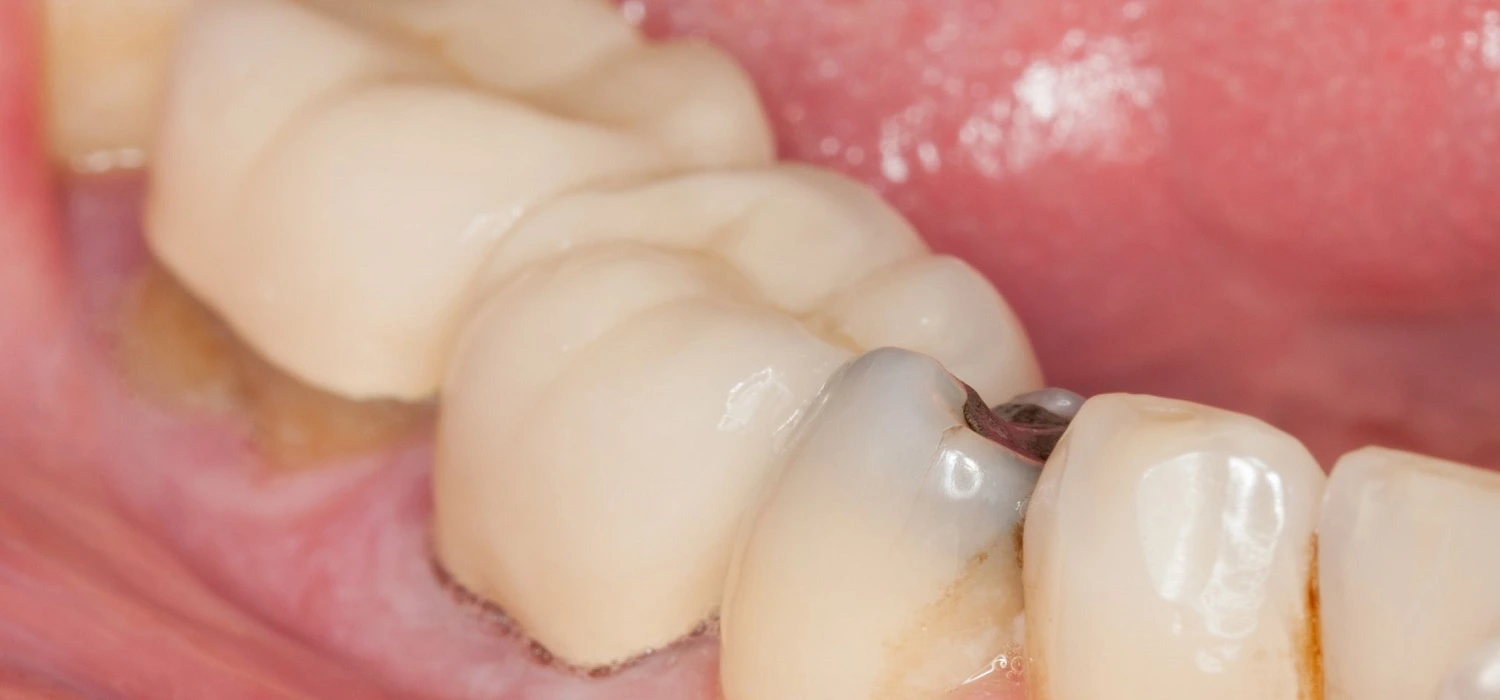 cavities-under-dental-crowns